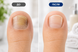 Пластырь против грибка ногтей / Royal Prestige Fungal Nail / Набор 16 пластырей